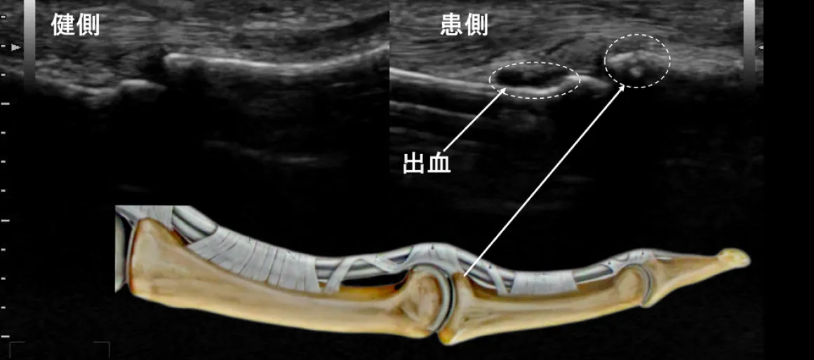 左第4指中節骨基部骨折のエコー画像